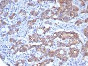 VIL1 Antibody for IHC. Immunohistochemistry analysis of Villin-1 (VIL1) in FFPE human colon adenocarcinoma using VIL1 Antibody / Enterocyte Functional Marker Antibody with recombinant rabbit monoclonal clone rVIL1/8336. HRP-DAB brown staining is observed in tumor epithelial cells with predominantly cytoplasmic and apical localization, highlighting gland-forming structures and luminal surfaces. The staining pattern supports Villin expression in enterocyte-like tumor cells and aligns with its role as a functional marker of intestinal epithelial activity and absorptive cell phenotype in colorectal adenocarcinoma.