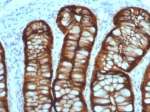 Villin Antibody. Immunohistochemistry analysis of Villin-1 (VIL1) in FFPE human colon adenocarcinoma using Villin Antibody / Microvillus Organization Protein Antibody with recombinant rabbit monoclonal clone VIL1/7378R. Strong HRP-DAB brown staining is observed along the apical membrane of tumor epithelial cells, outlining glandular luminal borders with a dense, continuous pattern consistent with organized microvillus structures. The prominent apical staining highlights actin bundle-rich regions within microvilli and supports Villin function as a microvillus organization protein regulating filament bundling, severing, and capping in epithelial cells.