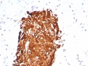 Inhibin alpha Antibody Recombinant Rabbit MAb (clone INHA/8872R) IHC staining of human testicular carcinoma. Immunohistochemistry analysis of FFPE human testicular carcinoma tissue using Inhibin alpha Antibody Recombinant Rabbit MAb (clone INHA/8872R) at 2 ug/ml shows strong HRP-DAB brown cytoplasmic staining in tumor cells, consistent with Inhibin subunit alpha (INHA) expression in steroidogenic or sex cord related tumor cells, while surrounding stromal elements remain largely negative. HIER: tissue sections were boiled in pH 9 10 mM Tris with 1 mM EDTA for 20 minutes and allowed to cool before testing.