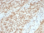 IHC staining of FFPE human colon tissue with Lynch disease with MutL Homolog 1 antibody (clone MLH1/7562). HIER: boil tissue sections in pH 9 10mM Tris with 1mM EDTA for 20 min and allow to cool before testing.