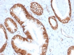IHC staining of FFPE human prostate carcinoma tissue with Beta Catenin antibody (clone CTNNB1/6807R). HIER: boil tissue sections in pH 9 10mM Tris with 1mM EDTA for 20 min and allow to cool before testing.
