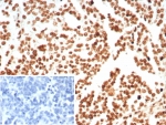 Histone H1 Antibody for IHC. Immunohistochemistry analysis of chromatin boundary-associated histone H1 expression in FFPE human ovarian carcinoma tissue using Histone H1 Antibody. Nuclear HRP-DAB brown staining is observed in tumor epithelial cells, consistent with localization of linker histone H1 within chromatin domains and its role in chromatin boundary formation and domain insulation. Clone rHH1/8702 antibody demonstrates strong nuclear compartmentalization with minimal cytoplasmic staining, reflecting chromatin-associated distribution across organized chromatin domains. Inset: PBS was used in place of the primary antibody as a negative control.