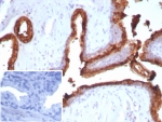 ACP3 Antibody for IHC analysis of Acid phosphatase 3 / Prostatic acid phosphatase in human prostate carcinoma tissue. FFPE human prostate carcinoma tissue was stained with ACP3 Antibody for IHC (mouse monoclonal, clone ACPP/2472) following heat induced epitope retrieval by boiling tissue sections in pH 9 Tris-EDTA buffer (10mM Tris, 1mM EDTA) for 20 minutes and cooling prior to staining. HRP-DAB brown chromogenic signal highlights strong membranous and cytoplasmic staining of prostate tumor epithelial cells forming glandular carcinoma structures, consistent with the known localization of Prostatic acid phosphatase (ACP3 / PAP) in prostate-derived epithelial cells. Detection of ACP3 in prostate carcinoma tissue sections supports its established role as a marker of prostate epithelial differentiation in prostate cancer research. The inset shows the PBS negative control where the primary antibody was omitted, demonstrating absence of specific staining.