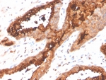 Prostatic acid phosphatase Antibody immunohistochemistry analysis of PAP / ACP3 in human prostate carcinoma tissue. FFPE human prostate carcinoma tissue was stained with Prostatic acid phosphatase Antibody (recombinant rabbit monoclonal, clone ACPP/4495R) following heat induced epitope retrieval by boiling tissue sections in pH 9 Tris-EDTA buffer (10mM Tris, 1mM EDTA) for 20 minutes prior to cooling and staining. HRP-DAB brown chromogenic signal highlights strong cytoplasmic and membranous staining of prostate tumor epithelial cells forming glandular carcinoma structures, consistent with the known localization of Prostatic acid phosphatase (ACP3 / PAP) in prostate-derived epithelial cells. Detection of PAP expression by immunohistochemistry is widely used in prostate cancer research to identify prostate epithelial lineage and evaluate Prostatic acid phosphatase expression in prostate carcinoma tissues.