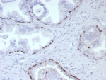 p63 Antibody. Immunohistochemistry analysis of Tumor protein 63 (TP63) in FFPE human prostate cancer tissue using a p63 antibody as a prostate basal cell marker (clone rP40/8765) demonstrates sparse HRP-DAB brown nuclear staining in scattered basal-like cells, while the majority of malignant glandular epithelial cells are negative. The staining is discontinuous and limited, reflecting loss of the basal cell layer that is characteristic of prostate adenocarcinoma. Residual TP63-positive nuclei highlight rare basal or progenitor-associated cells at the periphery of glandular structures. The nuclear-restricted signal and clear absence of staining in tumor cells support the role of TP63 as a marker of basal cell integrity in prostate tissue. Heat-induced epitope retrieval was performed by boiling tissue sections in pH 9 10mM Tris with 1mM EDTA for 20 minutes followed by cooling prior to antibody incubation.
