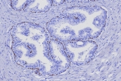 TP63 Antibody Human Prostate Cancer Tissue IHC. Immunohistochemistry staining of FFPE human prostate cancer tissue with TP63 antibody (clone TP63/7807R). HIER: boil tissue sections in pH 9 10mM Tris with 1mM EDTA for 20 min and allow to cool before testing.