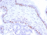 p40 Antibody / Squamous Lineage Determination Marker Antibody. Immunohistochemistry analysis of Tumor protein p40 (deltaNp63) in FFPE human prostate carcinoma tissue using a p40 antibody (clone P40/8225R) demonstrates distinct HRP-DAB brown nuclear staining in basal epithelial cells outlining residual benign glandular structures, while malignant luminal tumor cells remain negative. The nuclear-restricted staining pattern highlights preserved basal cell layers and clearly contrasts with carcinoma regions lacking basal cells, supporting interpretation of epithelial lineage and glandular architecture. Surrounding stromal cells show minimal staining, providing clean background and strong signal specificity. Heat-induced epitope retrieval was performed by boiling tissue sections in pH 9 10mM Tris with 1mM EDTA for 20 minutes followed by cooling prior to antibody incubation.