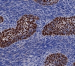 p40 Antibody. Immunohistochemistry analysis of FFPE human lung carcinoma tissue demonstrates strong HRP-DAB brown nuclear staining in tumor cell clusters consistent with squamous differentiation, while surrounding stromal cells remain negative. The nuclear-restricted staining pattern supports use of this antibody as a squamous lineage determination marker, highlighting epithelial tumor cells and enabling clear distinction from non-squamous components. Staining is intense and well-defined, allowing accurate interpretation of tumor phenotype and cellular organization. Expression is consistent with deltaNp63, a TP63 isoform associated with squamous epithelial lineage commitment. Heat-induced epitope retrieval was performed by boiling tissue sections in pH 9 10mM Tris with 1mM EDTA for 20 minutes followed by cooling prior to antibody incubation.