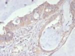 PDGFRA Antibody Colon Cancer IHC. Immunohistochemistry staining of FFPE human colon cancer tissue using PDGFRA Antibody / Receptor Tyrosine Kinase Antibody (clone PDGFRA/7407) demonstrates membranous and cytoplasmic HRP-DAB brown staining within malignant gland-forming epithelial cells. The staining pattern is consistent with expression of PDGFRA, a receptor tyrosine kinase that mediates platelet-derived growth factor signaling and regulates cellular proliferation, migration, differentiation, and survival. PDGFRA contributes to growth factor-dependent communication within the tumor microenvironment and has been widely studied in cancer biology due to its roles in cellular growth regulation and tissue remodeling. HIER was performed by boiling tissue sections in pH 9, 10 mM Tris with 1 mM EDTA for 20 minutes followed by cooling prior to immunostaining.