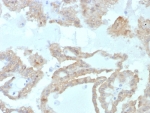 Fatty Acid Binding Protein 2 Antibody RCC IHC. Immunohistochemistry staining of FFPE human renal cell carcinoma tissue with FABP2 antibody (clone FABP2/7669). HIER: boil tissue sections in pH 9 10mM Tris with 1mM EDTA for 20 min and allow to cool before testing.