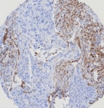 IHC staining of FFPE human lung carcinoma with STING1 antibody STING1/7439. Inset: PBS used in place of primary Ab (secondary Ab negative control). HIER: boil tissue sections in pH 9 10mM Tris with 1mM EDTA for 20 min and allow to cool before testing.