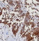ERIS Antibody STING1/8187R in Human Serous Ovarian Carcinoma IHC. Immunohistochemistry staining of FFPE human serous ovarian carcinoma tissue with ERIS Antibody, clone STING1/8187R. HIER was performed by boiling tissue sections in pH 9 10 mM Tris with 1 mM EDTA for 20 min followed by cooling before testing. Strong brown cytoplasmic immunoreactivity is visible in numerous tumor-associated cells, with heterogeneous staining across the tissue. The result demonstrates detection of STING1, also known as Endoplasmic Reticulum Interferon Stimulator, within the human ovarian carcinoma microenvironment.