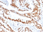 Immunohistochemistry analysis of MCM3 antibody (clone MCM3/6706) in human colon carcinoma tissue. Formalin-fixed, paraffin-embedded human colon carcinoma shows strong nuclear brown staining in malignant epithelial cells, consistent with MCM3 expression in actively proliferating tumor cells, while surrounding stromal cells display weaker or focal nuclear signal. Heat-induced epitope retrieval was performed by boiling tissue sections in pH 9 10mM Tris with 1mM EDTA for 20 min followed by cooling prior to staining.