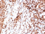 HLA-DR Antibody Rabbit Monoclonal HLA-DRA/6840R immunohistochemistry staining of human tonsil tissue. IHC analysis of FFPE human tonsil demonstrates HRP-DAB brown staining of numerous lymphoid cells using rabbit monoclonal HLA-DR antibody clone HLA-DRA/6840R. Heat induced epitope retrieval was performed by boiling tissue sections in pH 9 10mM Tris with 1mM EDTA for 20 min followed by cooling before staining. The staining pattern highlights membranous and cytoplasmic signal in immune cells consistent with expression of Human leukocyte antigen DR alpha / HLA-DRA on antigen-presenting cells including B lymphocytes and other leukocytes within tonsillar lymphoid tissue.