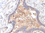 IL6 Antibody COVID-Positive Human Lung Tissue IHC. Immunohistochemical staining of FFPE COVID-positive human lung tissue using IL6 Antibody / Interleukin-6 Antibody (clone IL6/4642) demonstrates prominent cytoplasmic HRP-DAB brown staining within inflammatory cellular infiltrates and pulmonary epithelial-associated compartments. The observed staining pattern is consistent with elevated IL6 expression in an inflamed lung microenvironment and reflects the established role of this pro-inflammatory cytokine in immune activation, cytokine signaling, and regulation of pulmonary inflammatory responses. Detection of IL6 within COVID-associated lung pathology supports the utility of this antibody for investigating cytokine-driven inflammation, immune-mediated tissue injury, and mechanisms of inflammatory disease progression. HIER: boil tissue sections in pH 9 10mM Tris with 1mM EDTA for 20 min and allow to cool before testing.