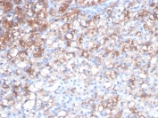 IHC staining of FFPE human renal cell carcinoma tissue with HSP27 / HSPB1 antibody (clone rHSPB1/7298). HIER: boil tissue sections in pH 9 10mM Tris with 1mM EDTA for 20 min and allow to cool before testing.