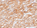 EPHB4 Antibody Liver Metastasis Colon IHC. Immunohistochemistry analysis of FFPE human liver metastasis in colon tissue using EPHB4 Antibody (clone EPHB4/6392) demonstrates HRP-DAB brown membranous and cytoplasmic staining in tumor cells, consistent with Eph receptor B4 / EPHB4 expression as a receptor tyrosine kinase involved in tumor signaling and vascular interactions, while surrounding stromal components show lower signal; nuclei are counterstained blue. HIER: boil tissue sections in pH 9 10 mM Tris with 1 mM EDTA for 20 min and allow to cool before testing.