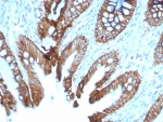 Cadherin 17 Antibody Colon IHC. Immunohistochemistry staining of FFPE human colon tissue with Cadherin 17 antibody (clone rCDH17/8512). HIER: boil tissue sections in pH 9 10mM Tris with 1mM EDTA for 20 min and allow to cool before testing.