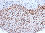 Enhancer of zeste homolog 2 Antibody Bladder Carcinoma IHC. Immunohistochemistry staining of FFPE human bladder carcinoma with Enhancer of zeste homolog 2 antibody (clone EZH2/6988). HIER: boil tissue sections in pH 9 10mM Tris with 1mM EDTA for 20 min and allow to cool before testing.