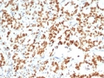 Enhancer of zeste homolog 2 Antibody Human Bladder Carcinoma Tissue IHC. Immunohistochemistry analysis of FFPE human bladder carcinoma with Enhancer of zeste homolog 2 antibody (clone EZH2/6988). HIER: boil tissue sections in pH 9 10mM Tris with 1mM EDTA for 20 min and allow to cool before testing.