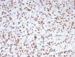 EZH2 Antibody Renal Cell Carcinoma RCC IHC. Immunohistochemistry staining of FFPE human renal cell carcinoma tissue with EZH2 antibody (clone EZH2/7507). HIER: boil tissue sections in pH 9 10mM Tris with 1mM EDTA for 20 min and allow to cool before testing.