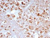 Carboxypeptidase A1 Antibody Pancreas IHC. Immunohistochemistry of Carboxypeptidase A1 / CPA1 in FFPE human pancreas tissue using rabbit monoclonal Carboxypeptidase A1 antibody, clone CPA1/8163R. Strong HRP-DAB brown cytoplasmic staining highlights pancreatic acinar cells, consistent with the enzymeâs localization to secretory granules and supporting its use as a pancreatic acinar cell marker, while nuclei are counterstained blue. Heat induced epitope retrieval was performed by boiling tissue sections in pH 9 10 mM Tris with 1 mM EDTA for 20 min followed by cooling prior to staining.