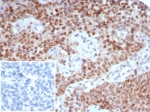Tricho-rhino-phalangeal syndrome type I Antibody immunohistochemistry analysis in human ovary tissue. FFPE human ovary tissue stained with Tricho-rhino-phalangeal syndrome type I Antibody shows strong nuclear staining in epithelial cells, consistent with TRPS1 localization as a transcription factor. A recombinant rabbit monoclonal format (clone TRPS1/7912R) was used for detection. The inset represents a negative control using PBS in place of the primary antibody, confirming staining specificity. Antigen retrieval was performed using pH 9 Tris-EDTA buffer with heat-induced epitope retrieval prior to staining, and hematoxylin counterstain highlights nuclei (blue).