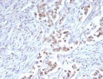 Tricho-rhino-phalangeal syndrome type I Antibody immunohistochemistry analysis in human breast carcinoma tissue. FFPE human breast carcinoma stained with Tricho-rhino-phalangeal syndrome type I Antibody demonstrates strong nuclear staining in tumor epithelial cells, consistent with TRPS1 expression as a nuclear transcription factor. Detection was performed using clone TRPS1/7912R at 2 ug/ml, showing clear nuclear localization within malignant cells. Antigen retrieval was carried out using pH 9 Tris-EDTA buffer with heat-induced epitope retrieval, and hematoxylin counterstain highlights nuclei (blue).