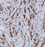TRPS1 Antibody immunohistochemistry analysis in human mammary gland carcinoma tissue. FFPE human mammary gland carcinoma stained with TRPS1 antibody demonstrates strong nuclear staining in tumor epithelial cells, consistent with TRPS1 localization as a transcription factor and its established role as a breast cancer marker. Detection was performed using recombinant rabbit monoclonal clone TRPS1/8008R. Antigen retrieval was carried out using pH 9 Tris-EDTA buffer with heat-induced epitope retrieval, and hematoxylin counterstain highlights nuclei (blue).