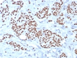 TRPS1 Antibody immunohistochemistry analysis in human breast carcinoma tissue. FFPE human breast carcinoma stained with TRPS1 antibody demonstrates strong nuclear staining in tumor epithelial cells, consistent with TRPS1 localization as a transcription factor and its role as a breast cancer-associated marker. Detection was performed using recombinant rabbit monoclonal clone TRPS1/8008R. Antigen retrieval was carried out using pH 9 Tris-EDTA buffer with heat-induced epitope retrieval, and hematoxylin counterstain highlights nuclei (blue).