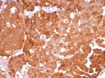 P16INK4a Antibody Ovarian Carcinoma IHC. Immunohistochemistry staining of FFPE human ovarian carcinoma tissue with P16INK4a antibody (clone CDKN2A/8223R). HIER: boil tissue sections in pH 9 10mM Tris with 1mM EDTA for 20 min and allow to cool before testing.