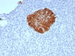 Immunohistochemistry of P16INK4a antibody in human cervical carcinoma tissue. The rabbit monoclonal clone CDKN2A/7660R demonstrates strong nuclear and cytoplasmic HRP-DAB brown staining in a discrete cluster of malignant epithelial cells, consistent with overexpression of Cyclin-dependent kinase inhibitor 2A in RB pathway dysregulation. Surrounding stromal and inflammatory cells show minimal to no specific staining, providing clear contrast with the positive tumor focus. Heat-induced epitope retrieval was performed by boiling tissue sections in pH 9 10mM Tris with 1mM EDTA for 20 minutes followed by cooling prior to antibody incubation.