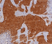 Immunohistochemistry of P16INK4a antibody in human bladder carcinoma tissue. The recombinant rabbit mAb clone CDKN2A/8196R demonstrates strong nuclear and cytoplasmic HRP-DAB brown staining within malignant urothelial cells, consistent with overexpression of Cyclin-dependent kinase inhibitor 2A in dysregulated cell cycle states. Tumor cell nests show diffuse positivity, while surrounding stromal elements display minimal background staining. Heat-induced epitope retrieval was performed by boiling tissue sections in pH 9 10mM Tris with 1mM EDTA for 20 minutes followed by cooling prior to antibody incubation.