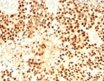Steroidogenic Factor 1 Antibody Adrenal Cortex IHC. Immunohistochemistry analysis of FFPE human adrenal cortex tissue stained with Steroidogenic Factor 1 Antibody demonstrates strong diffuse nuclear HRP-DAB brown staining throughout adrenal cortical cellular populations, consistent with expression of steroidogenic factor 1 / NR5A1 in steroid-producing endocrine tissue compartments. This steroidogenic transcription factor antibody highlights nuclear localization patterns associated with adrenal differentiation, steroid hormone biosynthesis, and endocrine-associated transcriptional regulation pathways. HIER: boil tissue sections in pH 9 10mM Tris with 1mM EDTA for 20 min and allow to cool before testing.