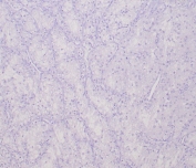 TFE3 Antibody for Immunohistochemistry. Negative control immunohistochemistry analysis of FFPE human clear cell renal cell carcinoma tissue using the recombinant rabbit monoclonal TFE3 antibody clone TFE3/6849R shows absence of nuclear HRP-DAB brown staining in tumor cells, confirming lack of detectable TFE3 protein in this tissue type. Clear cell RCC typically lacks TFE3 overexpression associated with MiT family translocation tumors, and the absence of nuclear staining supports assay specificity. Hematoxylin counterstain marks nuclei in blue. The recombinant rabbit monoclonal antibody clone TFE3/6849R was used at 2 ug/ml. Heat-induced epitope retrieval was performed by boiling tissue sections in pH 9 10mM Tris with 1mM EDTA for 20 minutes followed by cooling prior to staining.