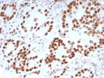 Androgen Receptor Antibody Rabbit Monoclonal DHTR/8698R immunohistochemistry of human prostate carcinoma. Formalin-fixed, paraffin-embedded human prostate carcinoma tissue stained with the rabbit monoclonal Androgen Receptor Antibody DHTR/8698R shows strong nuclear HRP-DAB brown chromogenic staining in malignant glandular epithelial cells, consistent with androgen receptor expression and the expected nuclear localization of this steroid hormone receptor transcription factor. Surrounding stromal cells show minimal staining, highlighting the predominance of AR-positive tumor epithelial cells within the prostate carcinoma. Heat-induced epitope retrieval was performed by boiling tissue sections in pH 9 10mM Tris with 1mM EDTA for 20 min followed by cooling prior to antibody incubation.