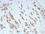 IHC staining of FFPE human breast carcinoma tissue with rabbit monoclonal Androgen Receptor antibody (clone DHTR/8698R). HIER: boil tissue sections in pH 9 10mM Tris with 1mM EDTA for 20 min and allow to cool before testing.