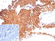 Uroplakin 1B Antibody immunohistochemistry analysis of Uroplakin 1B / UPK1B antibody in human bladder carcinoma tissue using clone UPK1B/9258R. FFPE sections show strong HRP-DAB brown membranous staining in tumor epithelial cells with prominent luminal surface accentuation, outlining apical cell borders consistent with polarized urothelial architecture. This Urothelial Apical Surface Protein Antibody highlights the luminal-facing membrane localization of UPK1B in urothelial tumor cells. Inset: PBS used in place of primary antibody shows no staining (negative control). HIER: boil tissue sections in pH 9 10mM Tris with 1mM EDTA for 20 minutes followed by cooling prior to staining.