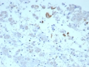 IL-6 Antibody Human Adrenal Gland Tissue IHC. Immunohistochemical staining of FFPE human adrenal gland tissue using IL-6 Antibody / Interleukin-6 Antibody (clone IL6/8713) demonstrates focal cytoplasmic HRP-DAB brown staining within scattered adrenal cellular populations. The observed staining pattern is consistent with expression of IL6, a multifunctional cytokine that regulates inflammatory signaling, immune cell communication, and tissue stress responses. Although staining is limited to discrete cell populations, the results support the presence of IL6-associated signaling activity within the adrenal microenvironment and demonstrate the utility of this antibody for studies of cytokine biology, endocrine-immune interactions, and inflammation-associated tissue responses. HIER: boil tissue sections in pH 9 10mM Tris with 1mM EDTA for 20 min and allow to cool before testing.
