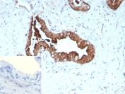 IHC staining of FFPE human prostate cancer tissue with recombinant KRT19 antibody (clone rKRT19/9108). Inset: PBS used in place of primary Ab (secondary Ab negative control). HIER: boil tissue sections in pH 9 10mM Tris with 1mM EDTA for 20 min and allow to cool before testing.
