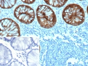 IHC staining of FFPE human colon tissue with E-cadherin Antibody / Tumor Suppression and EMT Marker Antibody (clone rCDH1/9615). Inset: PBS used in place of primary Ab (secondary Ab negative control). HIER: boil tissue sections in pH 9 10mM Tris with 1mM EDTA for 20 min and allow to cool before testing.