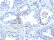 IHC staining of FFPE human prostate carcinoma tissue with recombinant KRT13 antibody (clone rKRT13/9623). Inset: PBS used in place of primary Ab (secondary Ab negative control). HIER: boil tissue sections in pH 9 10mM Tris with 1mM EDTA for 20 min and allow to cool before testing.