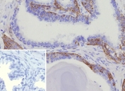 IHC staining of FFPE human prostate cancer tissue with recombinant CK15 antibody (clone KRT15/9088R). Inset: PBS used in place of primary Ab (secondary Ab negative control). HIER: boil tissue sections in pH 9 10mM Tris with 1mM EDTA for 20 min and allow to cool before testing.