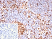 IHC staining of FFPE human lymph node tissue with Caspase 3 antibody (clone CASP3/8446). Inset: PBS used in place of primary Ab (secondary Ab negative control). HIER: boil tissue sections in pH 9 10mM Tris with 1mM EDTA for 20 min and allow to cool before testing.