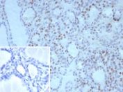 IHC staining of FFPE human thyroid tissue with NKX2.1 antibody (clone NX2.1/9030). Inset: PBS used in place of primary Ab (secondary Ab negative control). HIER: boil tissue sections in pH 9 10mM Tris with 1mM EDTA for 20 min and allow to cool before testing.