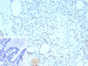 TTF-1 Antibody for IHC / TTF-1 Immunohistochemistry Antibody (clone NX2.1/9035) immunohistochemistry analysis of human thyroid tissue. Formalin-fixed, paraffin-embedded human thyroid tissue stained with mouse monoclonal clone NX2.1/9035 antibody demonstrates nuclear staining in thyroid follicular epithelial cells, consistent with the nuclear localization of Thyroid transcription factor 1 (TTF-1 / NKX2-1). The nuclear immunoreactivity highlights TTF-1 expression in follicular epithelial cells detected by immunohistochemistry in FFPE thyroid tissue sections. Inset: PBS used in place of primary antibody (secondary antibody negative control). HIER: boil tissue sections in pH 9 10mM Tris with 1mM EDTA for 20 min and allow to cool before testing.