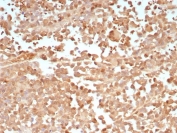 PRAME Antibody Melanoma IHC. Immunohistochemistry analysis of FFPE human melanoma tissue stained with PRAME antibody clone PRAME/9188. Tumor cells demonstrate diffuse nuclear and cytoplasmic HRP-DAB brown staining consistent with expression of Preferentially expressed antigen in melanoma / PRAME, a cancer-testis antigen involved in transcriptional regulation and tumor-associated immune signaling pathways. HIER: Tris/EDTA, pH 9.0, 45 min. Incubation with HRP-polymer secondary reagent for 30 min followed by DAB development for 5 min.