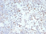 Opa-interacting Protein 4 Antibody Tumor IHC. Immunohistochemistry analysis of FFPE human tumor tissue stained with Opa-interacting Protein 4 Antibody / Tumor Antigen clone PRAME/9189. Tumor cell populations demonstrate variable nuclear HRP-DAB brown staining consistent with expression of Opa-interacting protein 4 / PRAME, a cancer-testis antigen associated with tumor-associated immune signaling and transcriptional regulation pathways commonly elevated in malignant tissues.