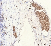 FLI1 Antibody Ewing Sarcoma IHC. Immunohistochemistry analysis of FFPE human Ewing sarcoma tissue stained with FLI1 Antibody / Ewing Sarcoma Marker (clone rFLI1/9614). Strong nuclear HRP-DAB brown staining is observed within malignant tumor cell populations, consistent with the expected nuclear localization of Friend leukemia integration 1 / FLI1 in EWSR1-FLI1-associated oncogenic transcriptional signaling pathways. Sections underwent HIER using 10mM Tris with 1mM EDTA buffer, pH 9, prior to immunostaining.