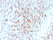 AKR1C1 Antibody Hepatocellular Carcinoma IHC. Immunohistochemistry analysis of FFPE human hepatocellular carcinoma tissue using AKR1C1 Antibody (clone AKR1C1/9063) shows cytoplasmic staining in tumor cells, consistent with AKR1C1 / Aldo-keto reductase family 1 member C1 localization as a cytosolic enzyme. The staining is heterogeneous across the tumor field, with variable intensity reflecting differences in metabolic activity among tumor cells. Surrounding non-tumor regions display comparatively lower signal. Hematoxylin counterstain provides nuclear contrast and tissue architecture. HIER: boil FFPE tissue sections in pH 9 10 mM Tris with 1 mM EDTA for 20 min and allow to cool before testing.